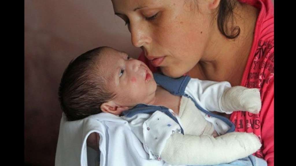 El día a día de Fran Olguín, el niño de 2 años que padece la piel de cristal