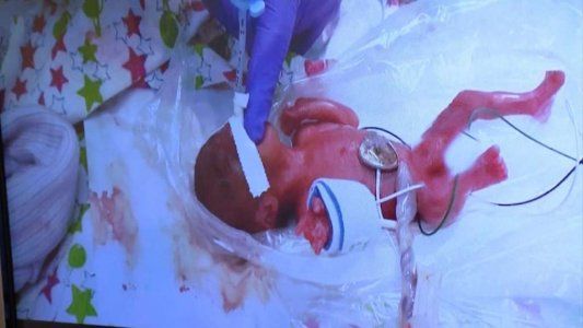 Nació la beba más pequeña del mundo: pesó solo 245 gramos de peso