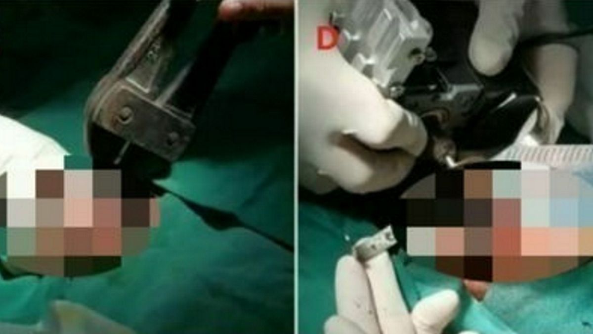 Las imágenes de la cirugía fueron publicadas en el Asian Journal of Surgery (Foto: AJoS).