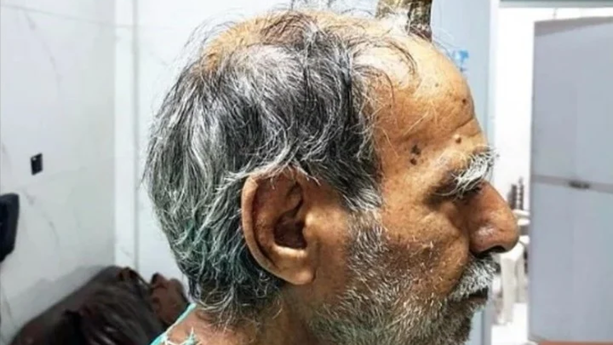 Se golpe&oacute; la cabeza y le creci&oacute; un tronco de &aacute;rbol en la herida&nbsp;
