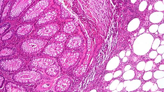 El gobernador de Salta lleva dos días internado por una diverticulitis aguda: ¿de qué se trata esta enfermedad?