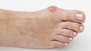 Juanetes en los pies: qué ejercicios recomienda un podólogo para evitar la operación y aliviar el dolor