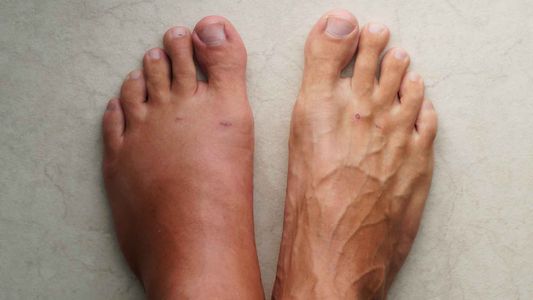 Pies, tobillos y piernas hinchados: las causas más frecuentes y cuándo puede ser una señal de alerta