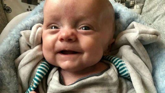 Aunque nació casi sin piel y prematuro, logró sobrevivir