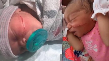 Por error en la cesárea le cortaron con el bisturí la carita a una bebé recién nacida
