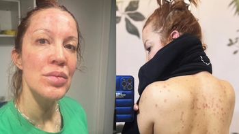 Las impactantes fotos y el duro relato de Miriam Lanzoni sobre el drama de salud que vivió: Me dolía mirarme