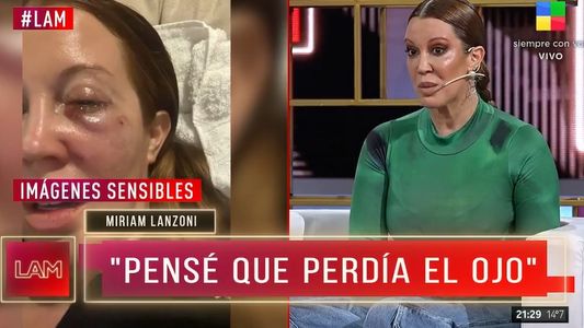 El dramático relato del accidente que sufrió Miriam Lanzoni, que casi le cuesta la visión