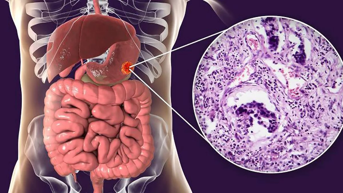 El v&iacute;nculo entre la sal y el c&aacute;ncer de est&oacute;mago.