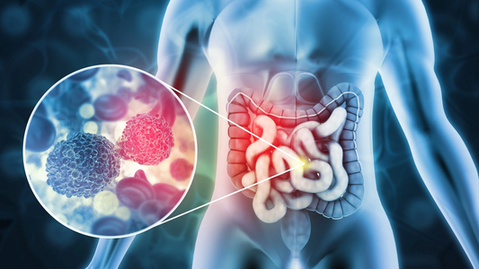 Cáncer de colon: lanzan tests gratuitos para detectar la enfermedad a tiempo