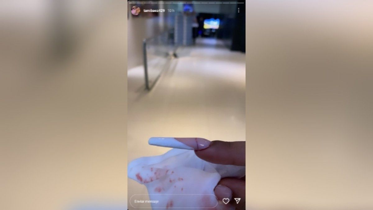 Tamara B&aacute;ez mostr&oacute; su u&ntilde;a partida sangrando desde sus historias virtuales.