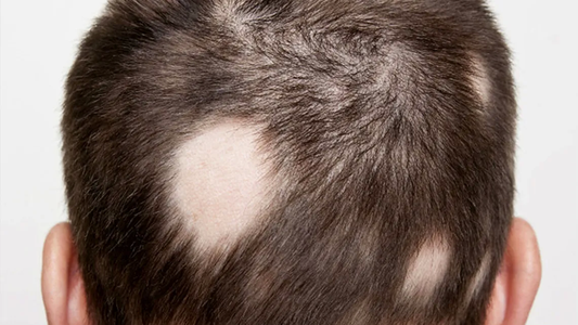 Aprueban la primera píldora para frenar la caída de cabello o alopecia: cómo funciona y qué chances hay de que llegue a la Argentina