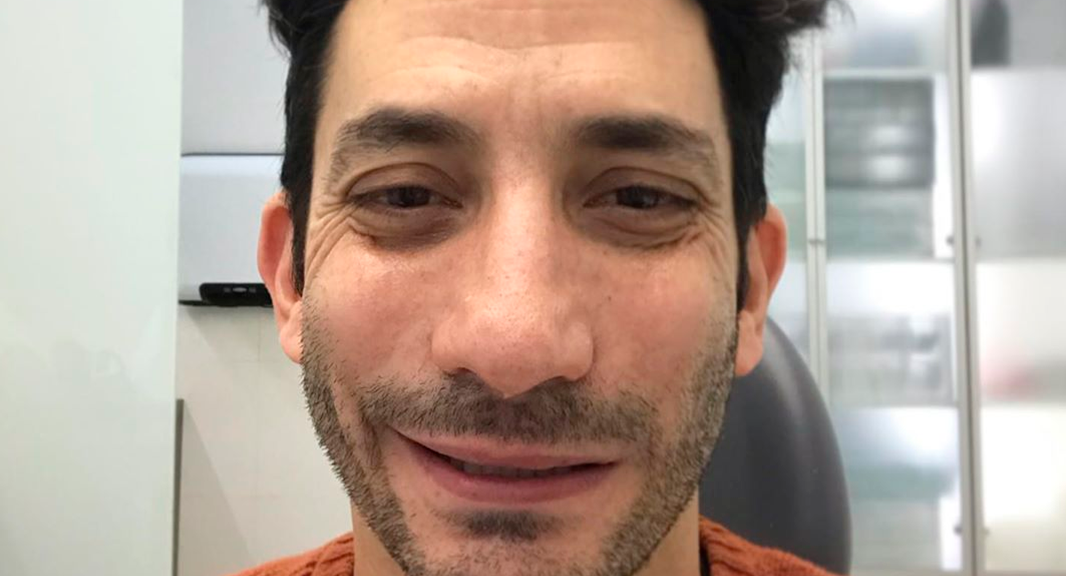 El actor Juan Minujín se operó de la boca en plena cuarentena