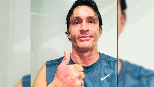 Sebastián Estevanez mostró cómo se recupera tras el accidente doméstico que le provocó quemaduras