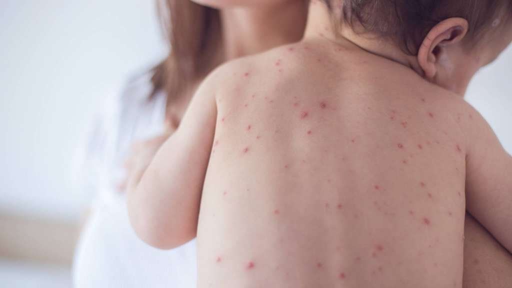 Una militante antivacunas y sus 5 hijos son los últimos casos confirmados del brote de Sarampión