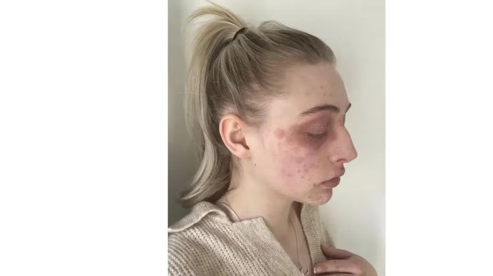 Se sometió a un tratamiento estético y el final no fue el esperado: Una pesadilla