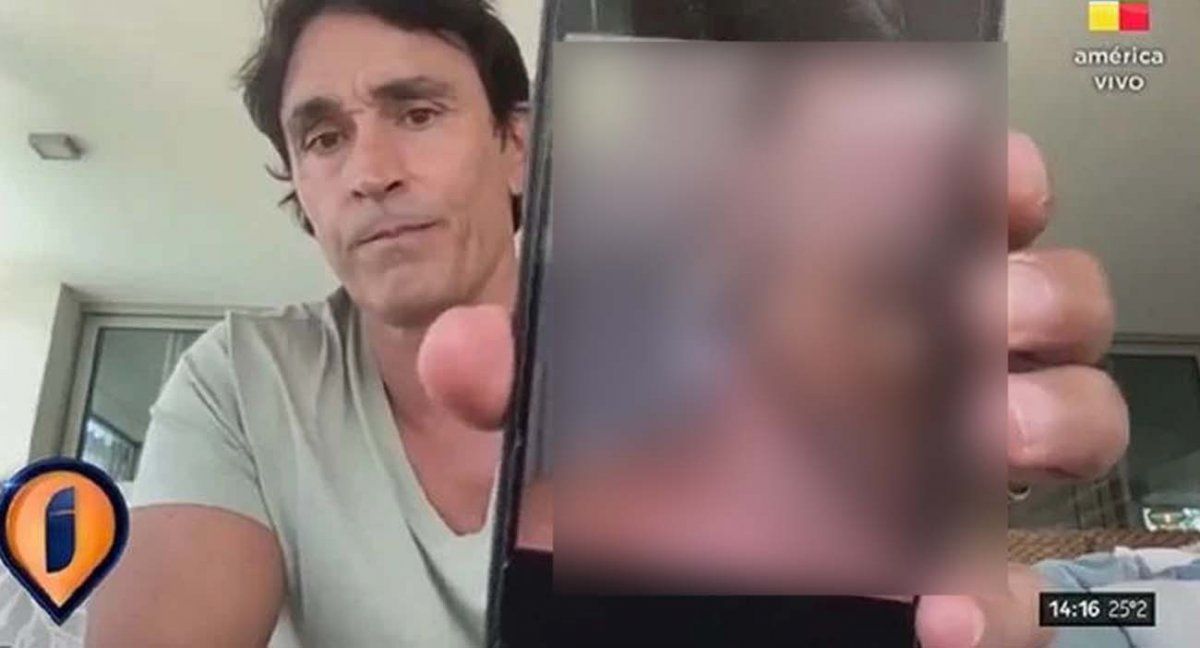 Sebastián Estevanez mostró las fotos de su cara quemada