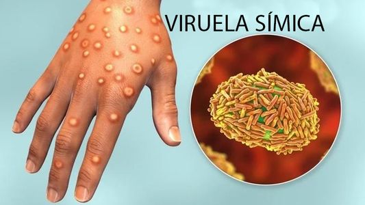 Viruela del mono en Argentina: ya son 170 los casos confirmados en siete provincias
