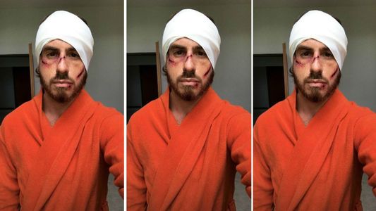 Federico Bal se fotografió golpeado, ¿qué le pasó?