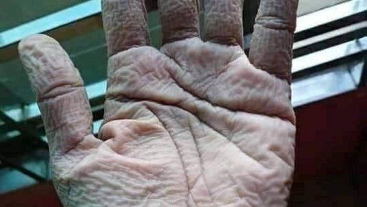 Foto: así le quedó la mano a un medico tras usar los guantes protectores contra el coronavirus