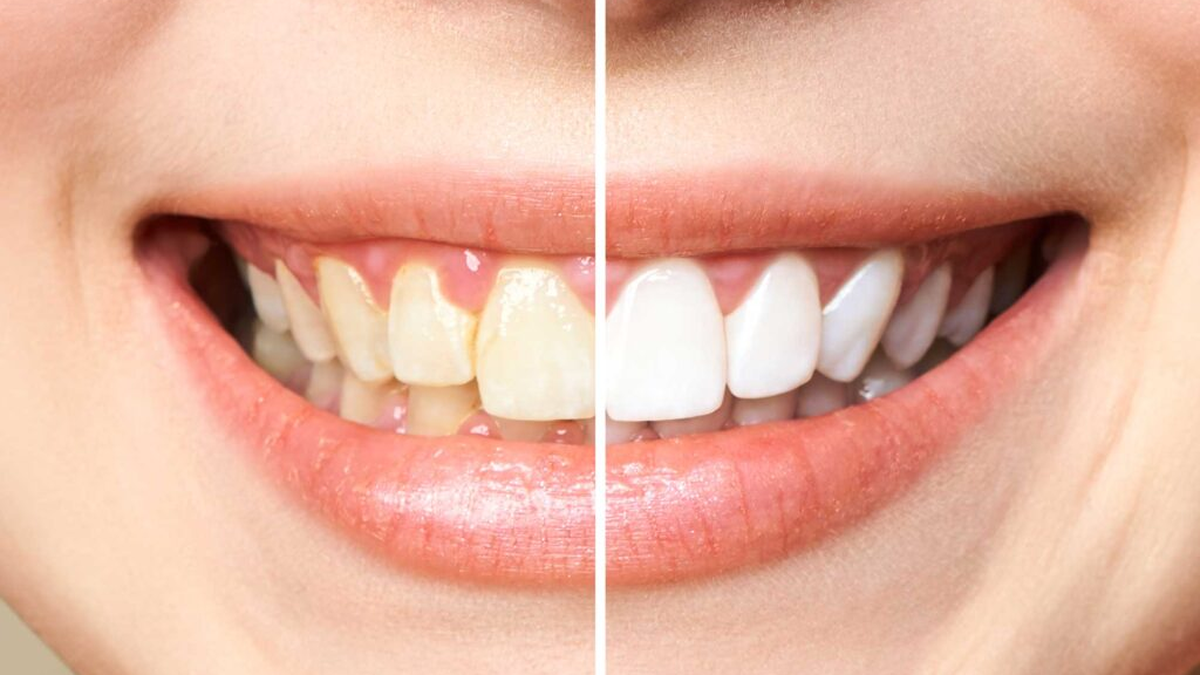 DILE adiós al sarro de los DIENTES con este trucazo casero DILE adiós al sarro de los DIENTES con este trucazo casero