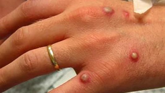 Viruela del mono: la ONU advierte ante comentarios racistas y homofóbicos