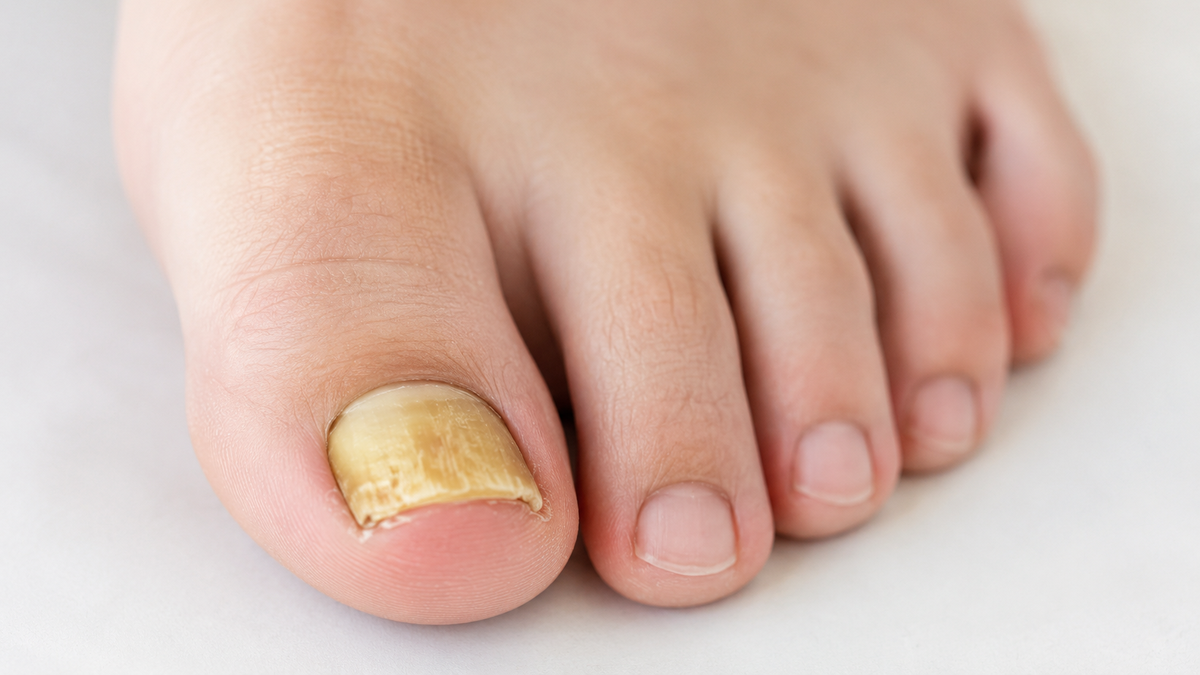 Las uñas amarillas