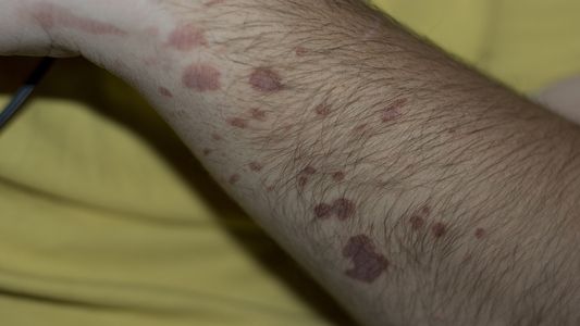 La OMS alertó por el avance de la lepra debido a la pandemia y el Papa Francisco pidió rezar por quienes la padecen