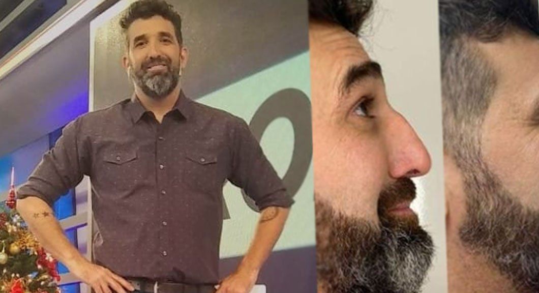 Diego Moranzoni se hizo una intervención en la nariz en vivo: soy otro