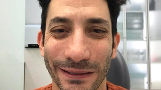 El actor Juan Minujín se operó de la boca en plena cuarentena