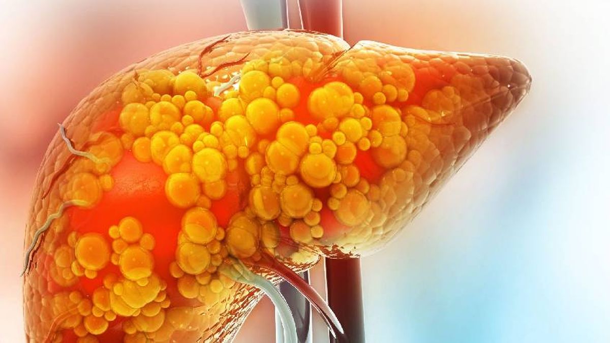 La esteatosis hepática