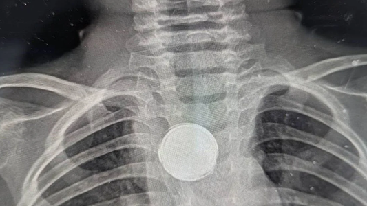 Se tragó una batería y le quedó cinco semanas atascada en la garganta: cómo pudo sobrevivir