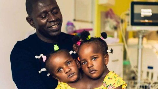 El drama de un padre: que mueran sus dos hijas siamesas o separarlas y que viva sólo una