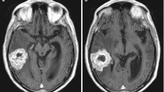 ¿Qué es el glioblastoma? La enfermedad de la que murió el juez Claudio Bonadio