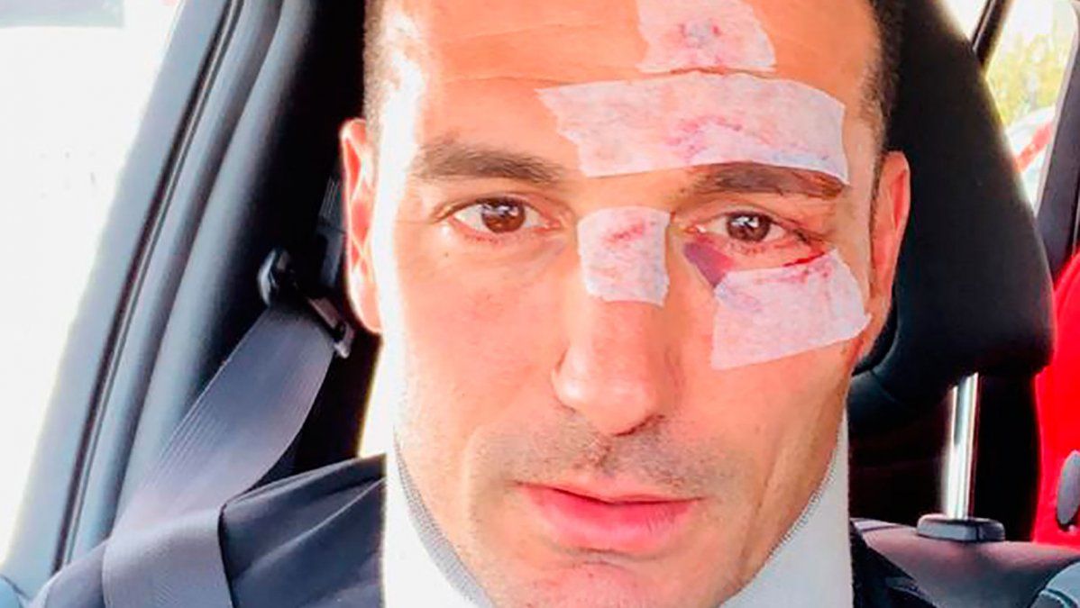 Lionel Scaloni fue atropellado por un auto en España y debió ser internado