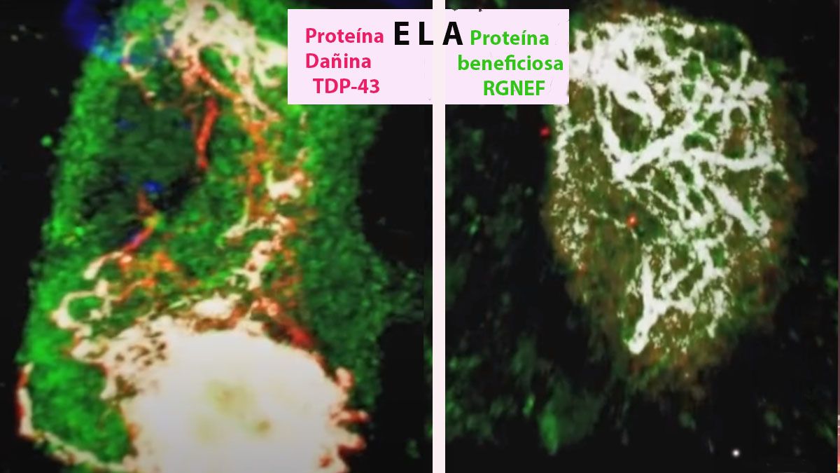Dos proteínas con funciones opuestas, la clave para la enfermedad de Esclerosis Lateral Amiotrófica. Una actúa sobre la que enferma y revierte el daño que provocó. (Foto: Captura de TV)