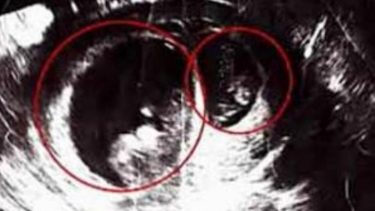 Rareza médica: una mujer se quedó embarazada cuando ya estaba embarazada
