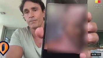 Sebastián Estevanez mostró las terribles fotos de su cara quemada