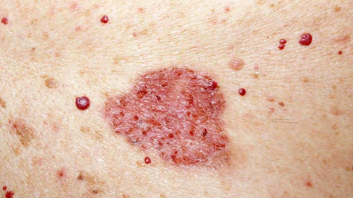 Qué es y cómo se previene el carcinoma del piel