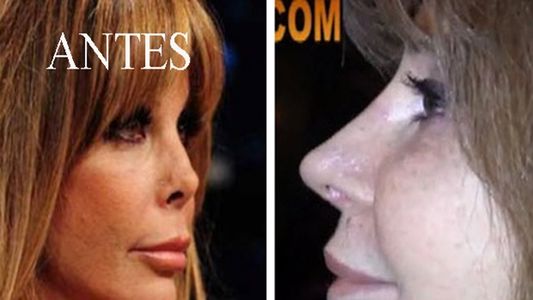 Así le quedó la nariz a Graciela Alfano tras la cirugía