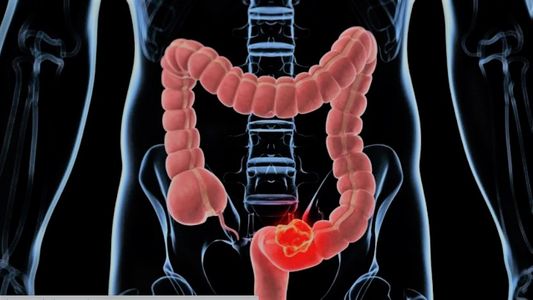 Desarrollan una calculadora para medir el riesgo de padecer cáncer de colon, el segundo más frecuente en Argentina