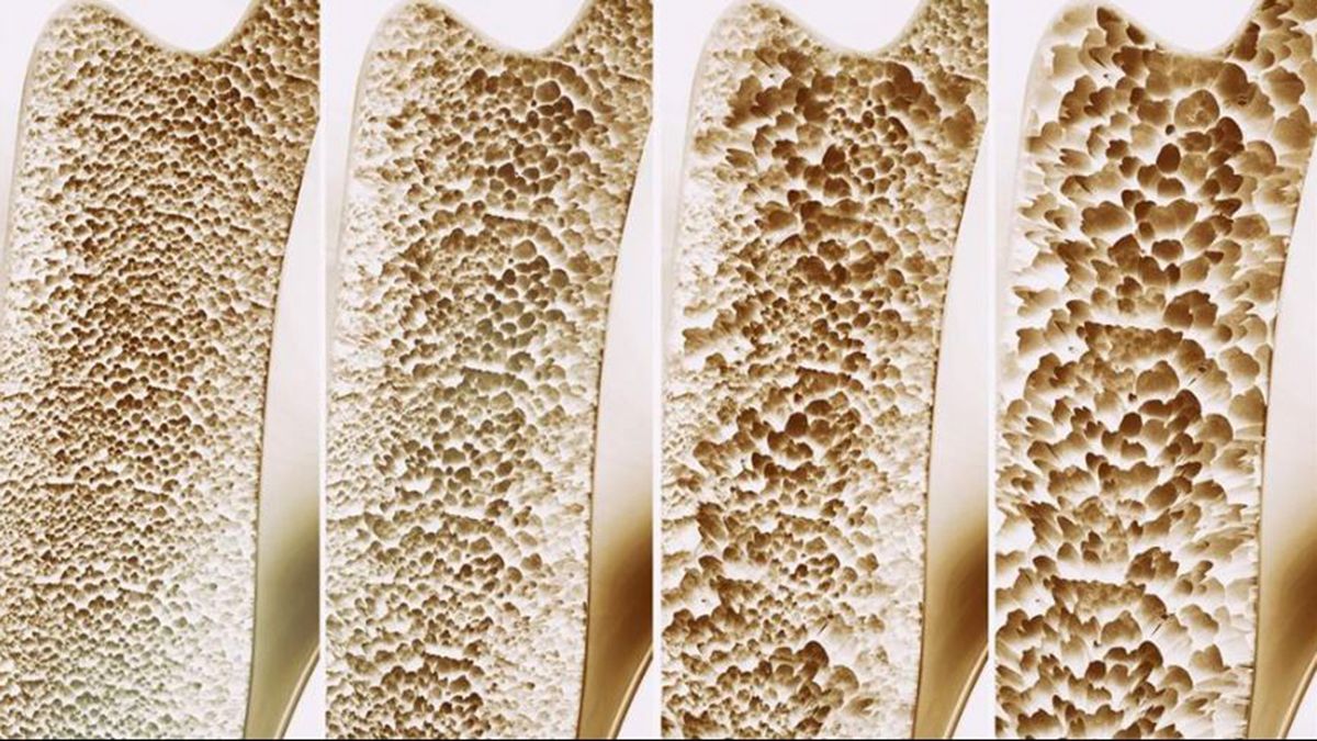 Cada 20 de octubre se conmemora el Día Mundial contra la Osteoporosis. (Foto: NatGeo)