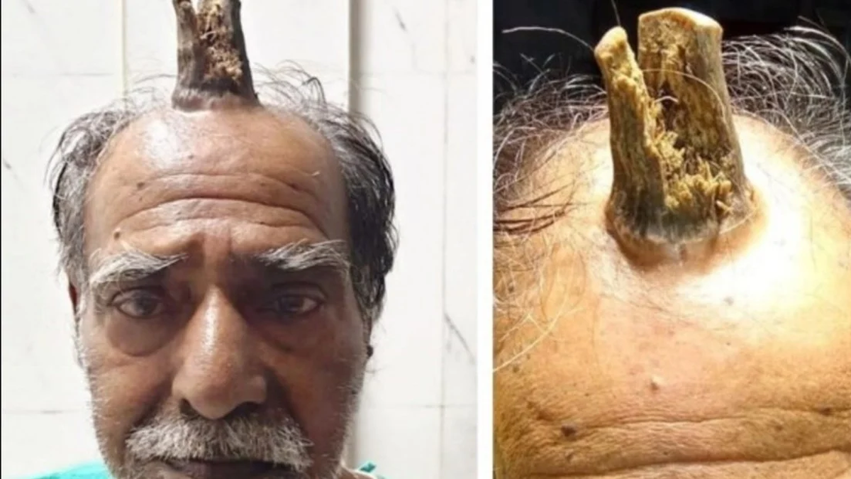 Se golpe&oacute; la cabeza y le creci&oacute; un tronco de &aacute;rbol en la herida&nbsp;