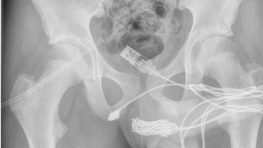 Tenía un cable USB en el pene: la increíble explicación que dio un joven de 15 años