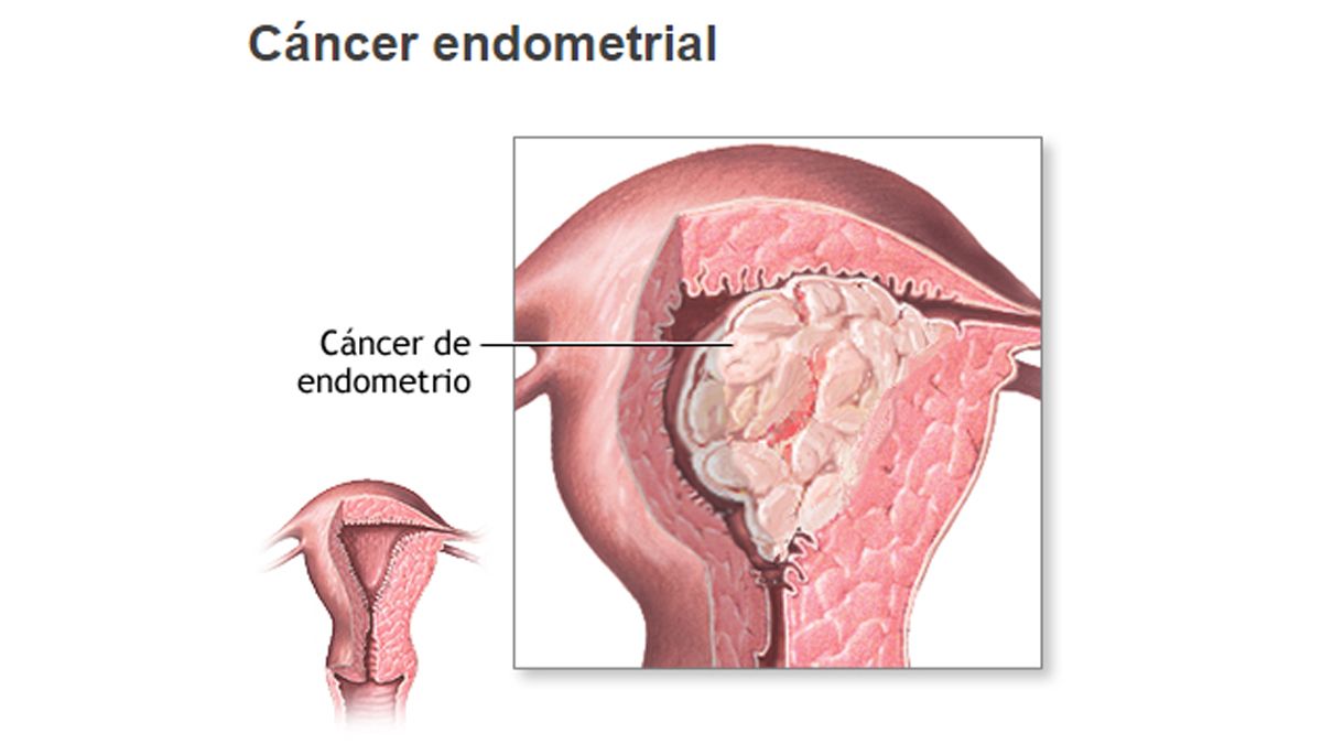 El cáncer endometrial es un tumor cancerígeno del endometrio (revestimiento del útero). y es el cáncer uterino más común. (Foto: A.D.A.M) 