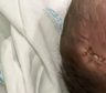 Beba recién nacida cayó de cabeza tras el parto y recibió 11 puntos de sutura