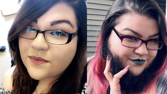 Después de 14 años afeitándose diariamente, mujer con hirsutismo se acepta a sí misma