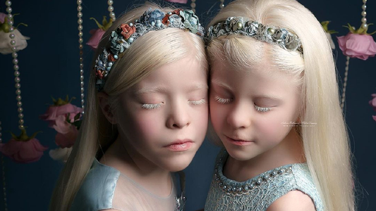 Albinos: las mellizas Valen y Mailén, su historia inspiradora y la lucha contra un tabú