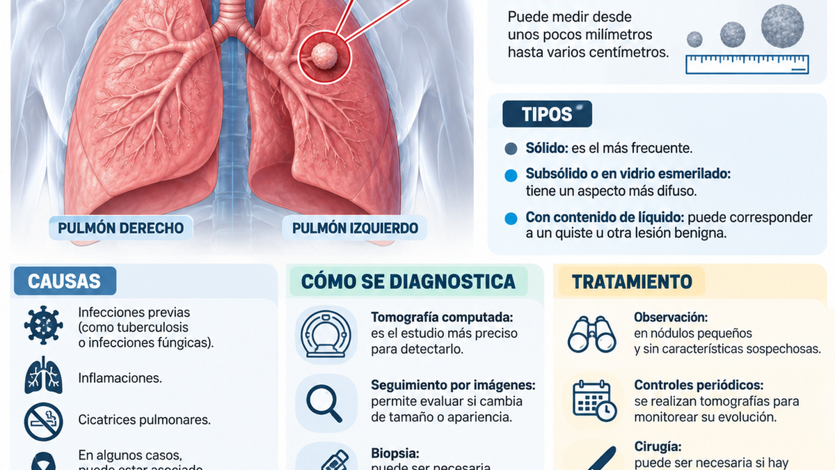 infografía. Qué es un nódulo pulmonar. El problema de salud de León XIV. (Foto: Archivo)