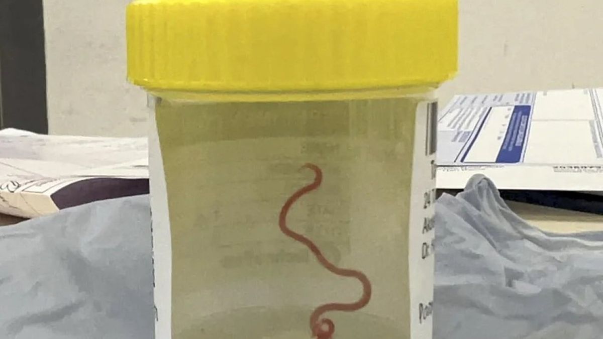 Médicos extrajeron un gusano del cerebro de una mujer. (Foto: lanoticiasv)