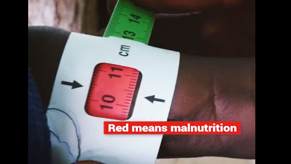 El brazalete en un niño de África, que marca su desnutrición (Foto: Unicef)